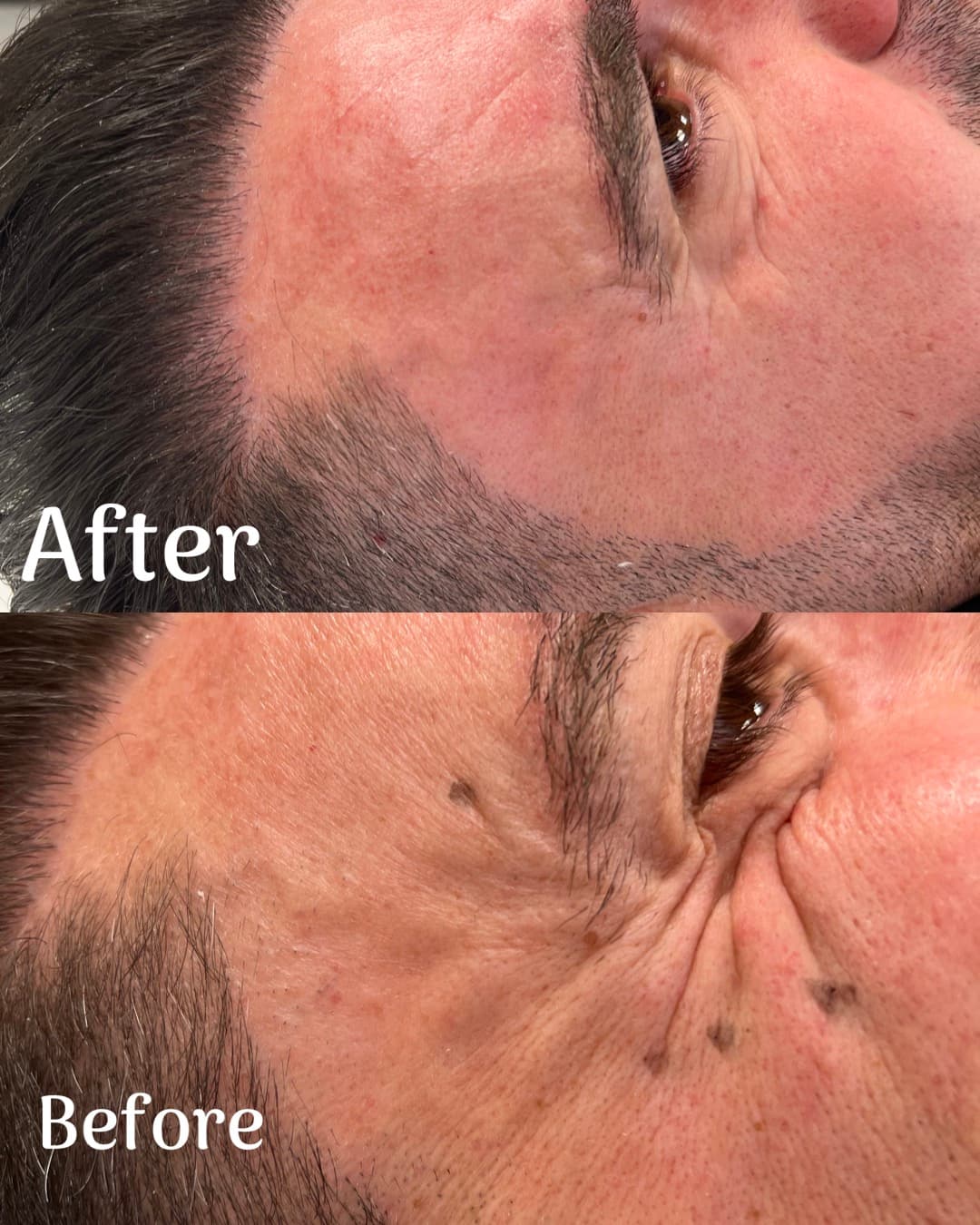 Före Nasolabialaveck