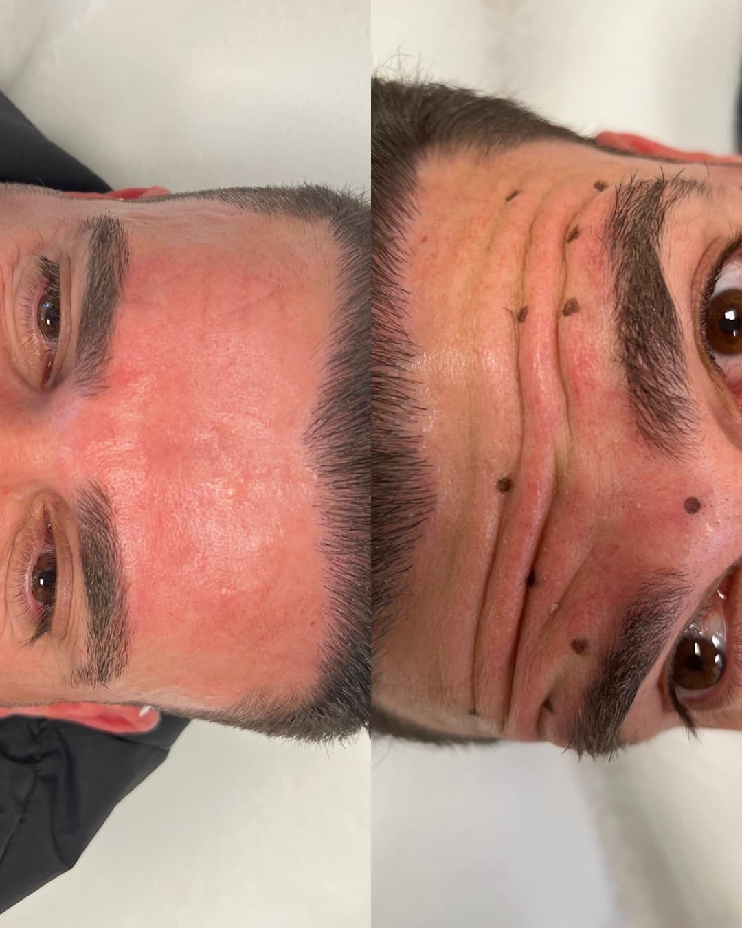 Efter Nasolabialaveck