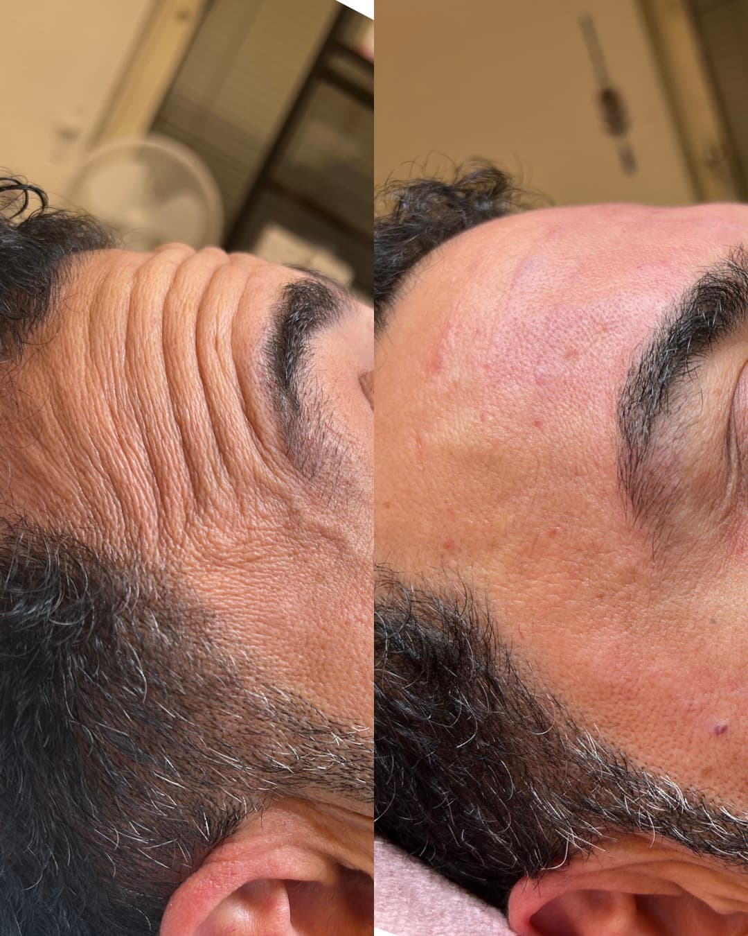 Före Nasolabialaveck