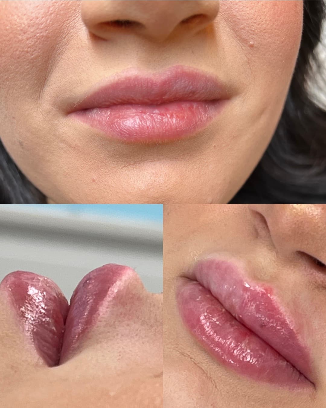 Före PRP-behandling