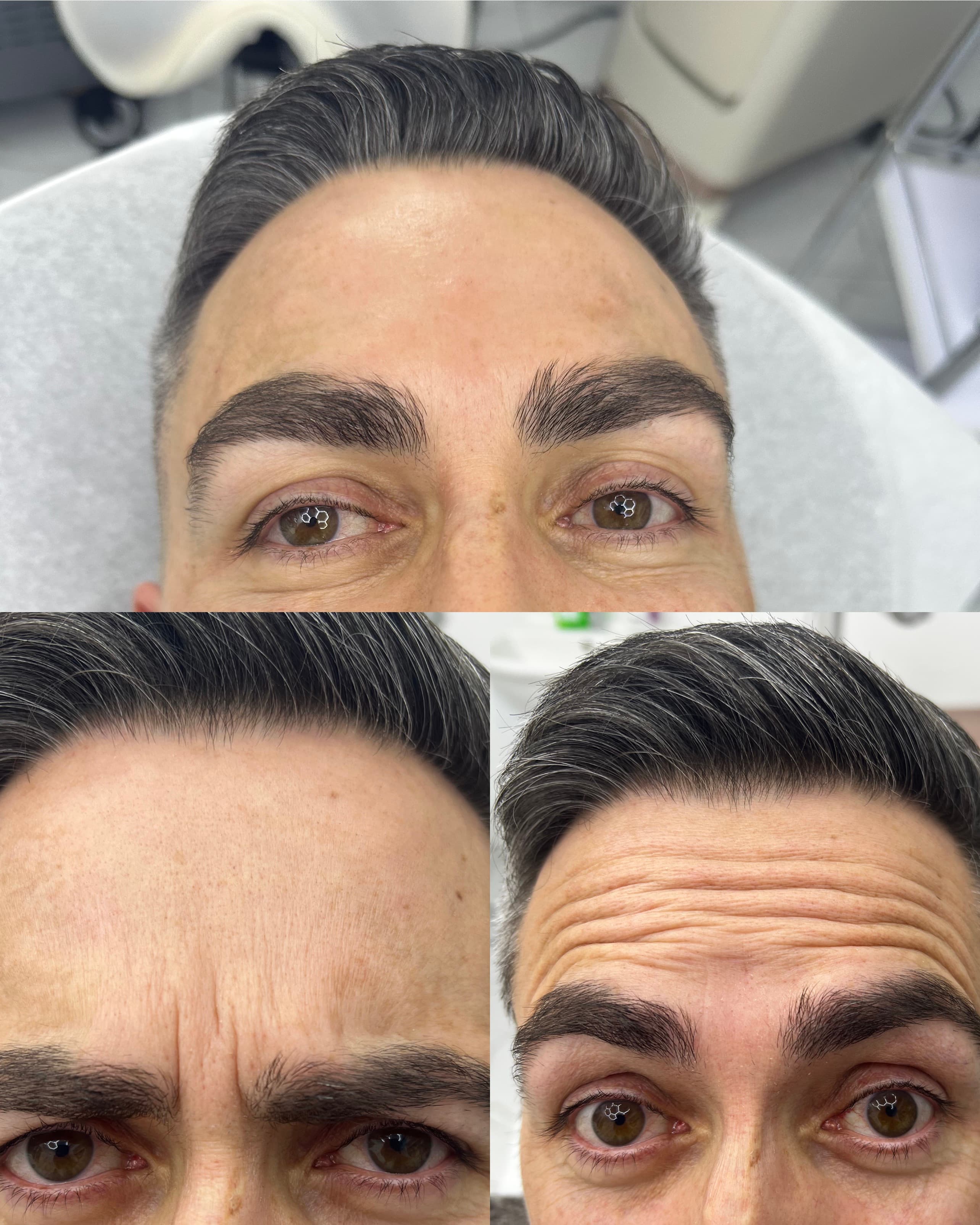 Efter Laserhårborttagning